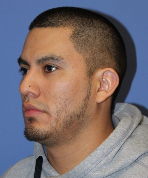 Facial Hair Transplant #6159 – click HERE for more views before photo. Individual results may vary.