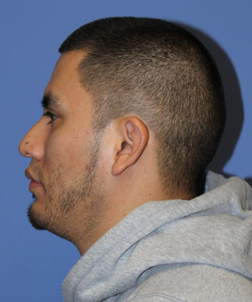 Facial Hair Transplant #6159 – click HERE for more views before photo. Individual results may vary.