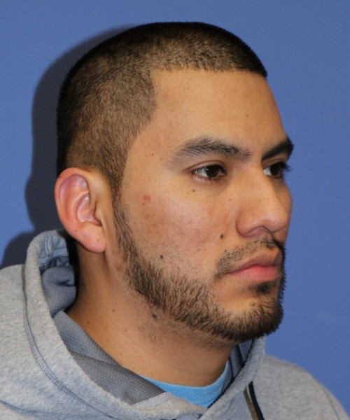 Facial Hair Transplant #6159 – click HERE for more views after photo. Individual results may vary.