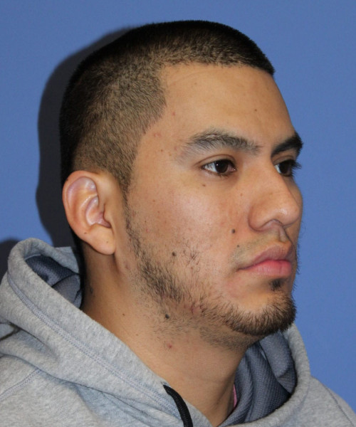 Facial Hair Transplant #6159 – click HERE for more views before photo. Individual results may vary.