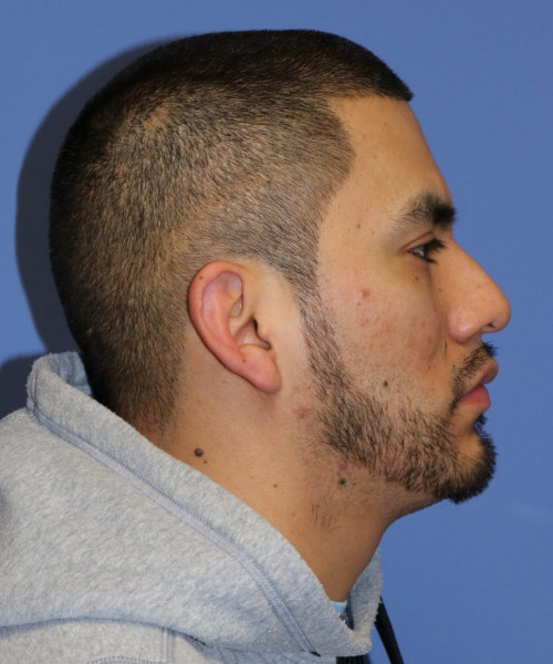 Facial Hair Transplant #6159 – click HERE for more views after photo. Individual results may vary.