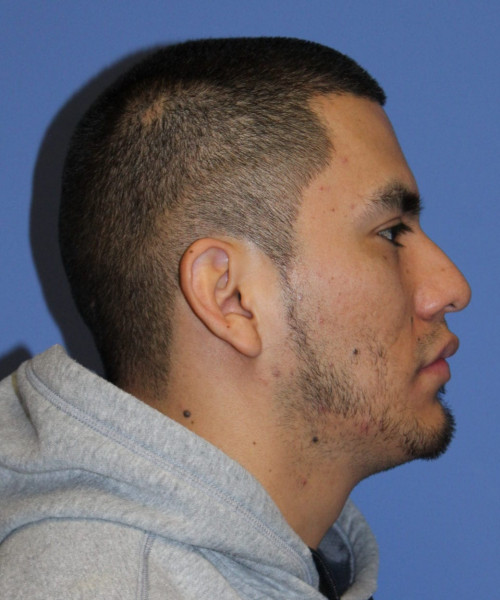Facial Hair Transplant #6159 – click HERE for more views before photo. Individual results may vary.