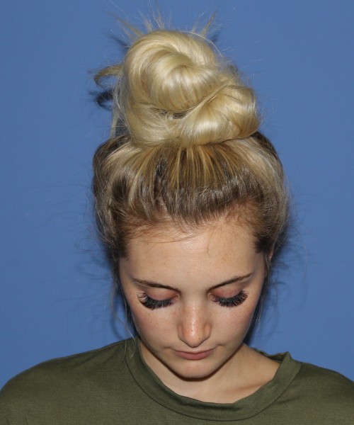 Rhinoplasty 0619 – Click HERE for more views after photo. Individual results may vary.