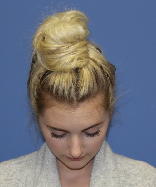 Rhinoplasty 0619 – Click HERE for more views before photo. Individual results may vary.