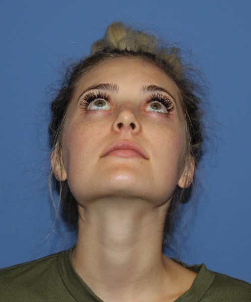Rhinoplasty 0619 – Click HERE for more views after photo. Individual results may vary.