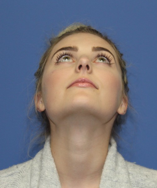 Rhinoplasty 0619 – Click HERE for more views before photo. Individual results may vary.