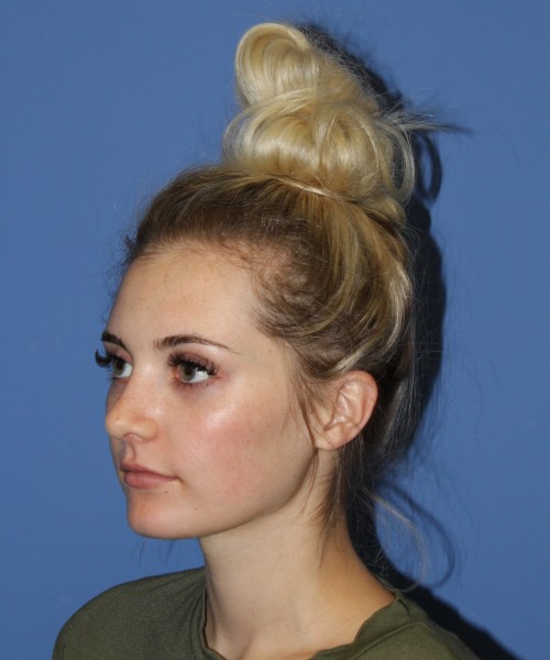 Rhinoplasty 0619 – Click HERE for more views after photo. Individual results may vary.