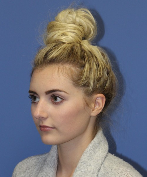 Rhinoplasty 0619 – Click HERE for more views before photo. Individual results may vary.