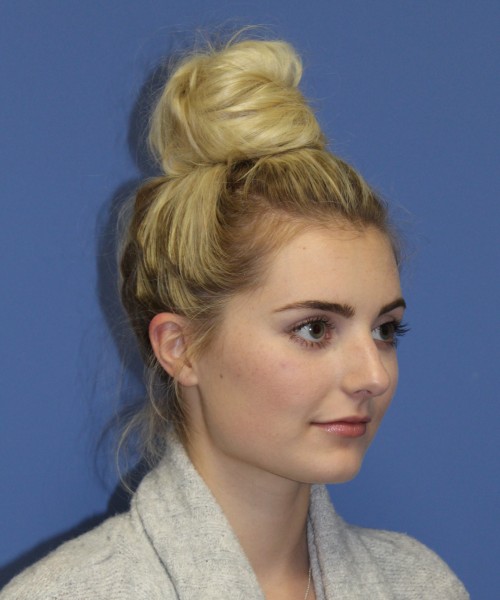 Rhinoplasty 0619 – Click HERE for more views before photo. Individual results may vary.