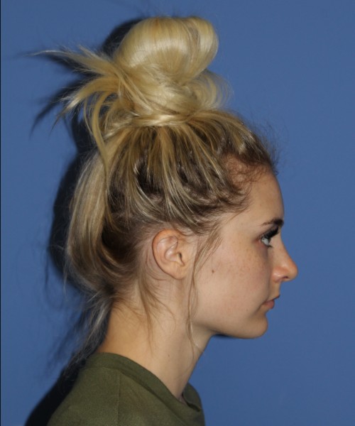 Rhinoplasty 0619 – Click HERE for more views after photo. Individual results may vary.