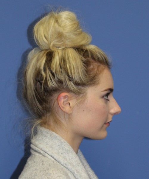 Rhinoplasty 0619 – Click HERE for more views before photo. Individual results may vary.
