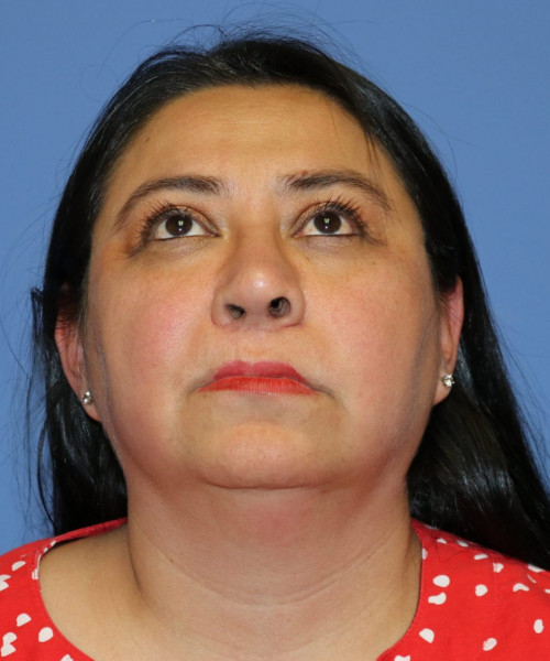 Rhinoplasty #6196 – click HERE for more views after photo. Individual results may vary.