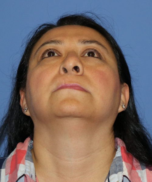 Rhinoplasty #6196 – click HERE for more views before photo. Individual results may vary.