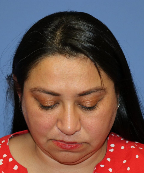 Rhinoplasty #6196 – click HERE for more views after photo. Individual results may vary.