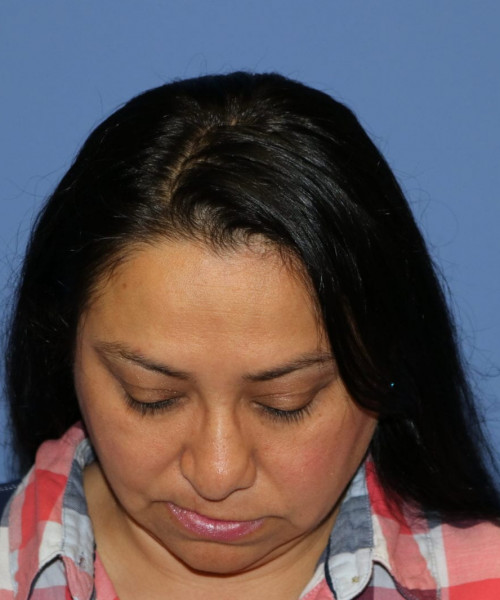 Rhinoplasty #6196 – click HERE for more views before photo. Individual results may vary.