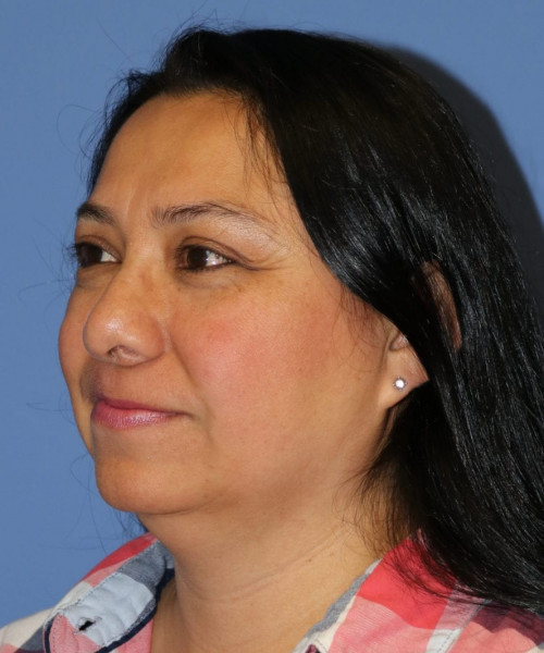 Rhinoplasty #6196 – click HERE for more views before photo. Individual results may vary.