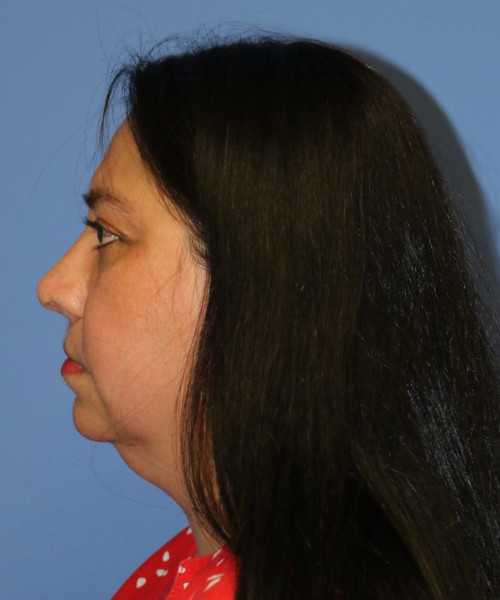 Rhinoplasty #6196 – click HERE for more views after photo. Individual results may vary.