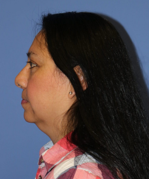 Rhinoplasty #6196 – click HERE for more views before photo. Individual results may vary.