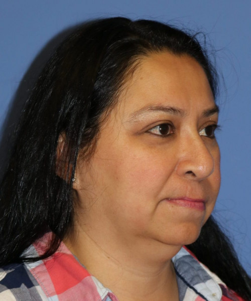 Rhinoplasty #6196 – click HERE for more views before photo. Individual results may vary.