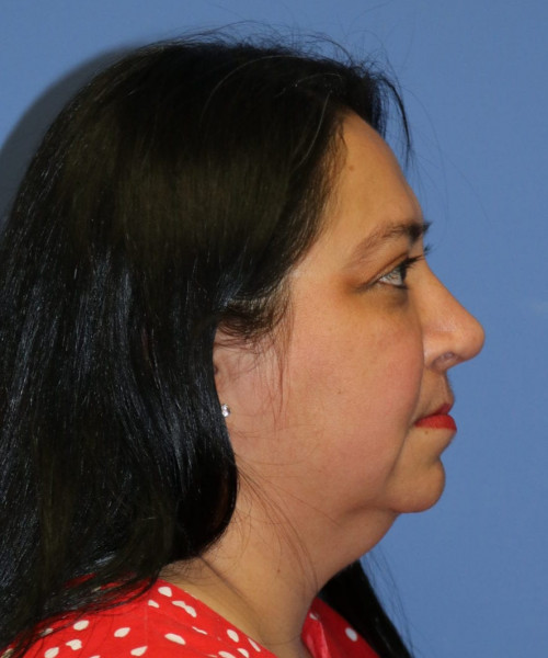 Rhinoplasty #6196 – click HERE for more views after photo. Individual results may vary.