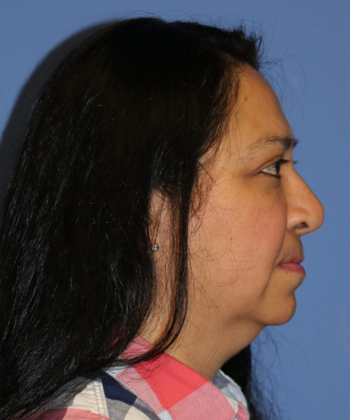 Rhinoplasty #6196 – click HERE for more views before photo. Individual results may vary.