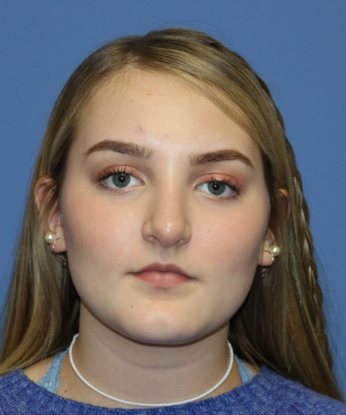Rhinoplasty #6228 – click HERE for more views after photo. Individual results may vary.