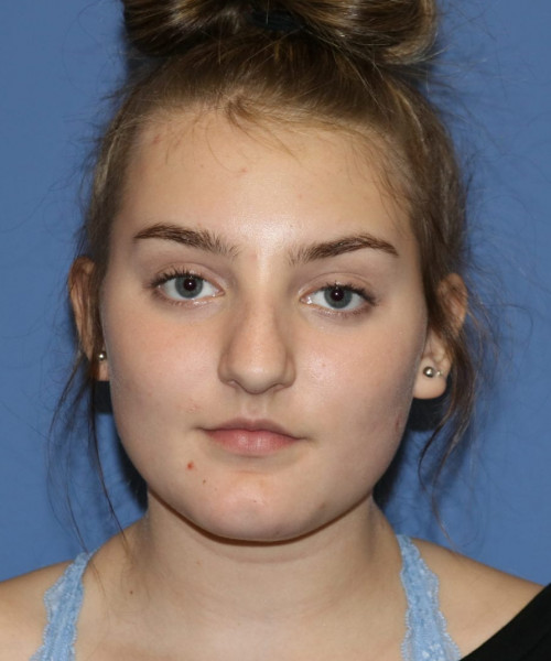 Rhinoplasty #6228 – click HERE for more views before photo. Individual results may vary.
