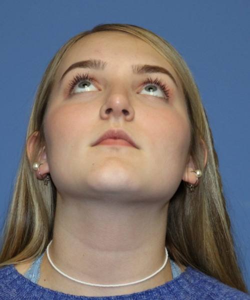 Rhinoplasty #6228 – click HERE for more views after photo. Individual results may vary.