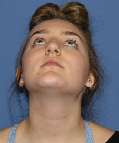 Rhinoplasty #6228 – click HERE for more views before photo. Individual results may vary.
