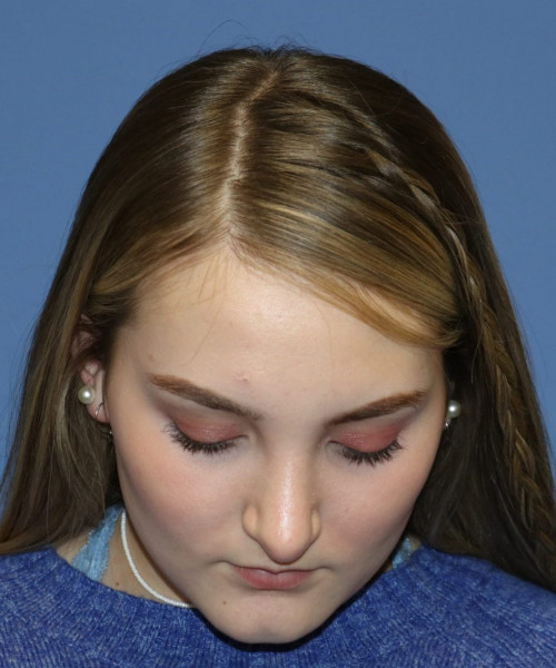 Rhinoplasty #6228 – click HERE for more views after photo. Individual results may vary.