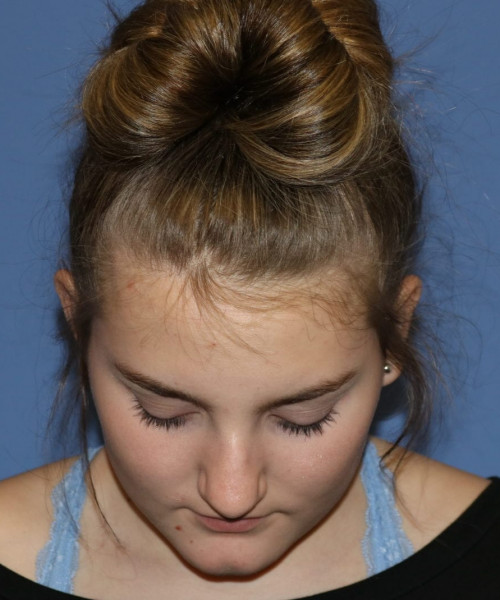 Rhinoplasty #6228 – click HERE for more views before photo. Individual results may vary.