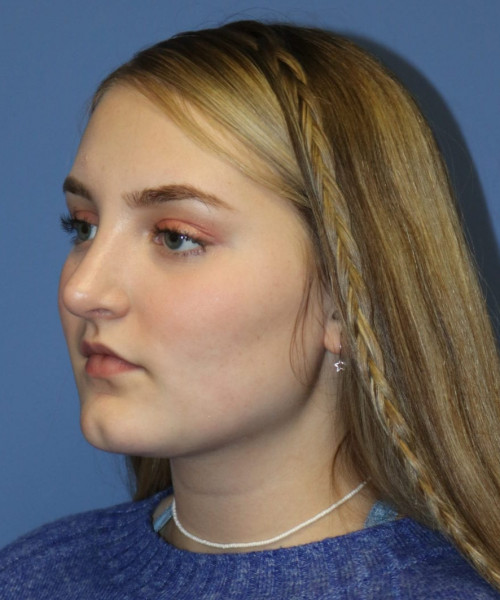 Rhinoplasty #6228 – click HERE for more views after photo. Individual results may vary.
