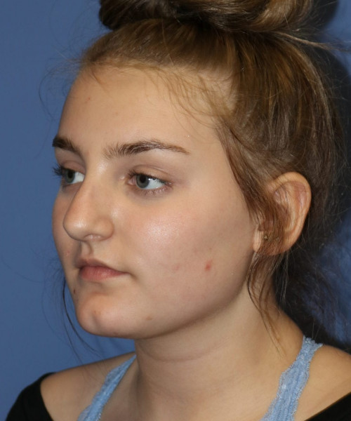 Rhinoplasty #6228 – click HERE for more views before photo. Individual results may vary.