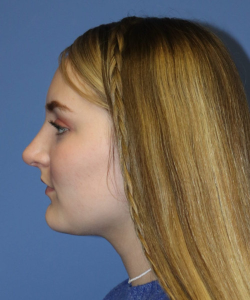 Rhinoplasty #6228 – click HERE for more views after photo. Individual results may vary.