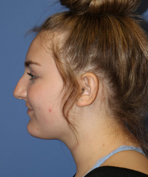 Rhinoplasty #6228 – click HERE for more views before photo. Individual results may vary.