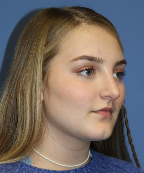 Rhinoplasty #6228 – click HERE for more views after photo. Individual results may vary.