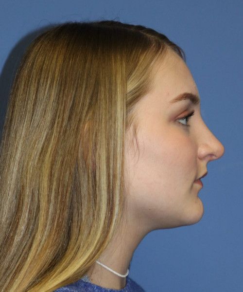 Rhinoplasty #6228 – click HERE for more views after photo. Individual results may vary.