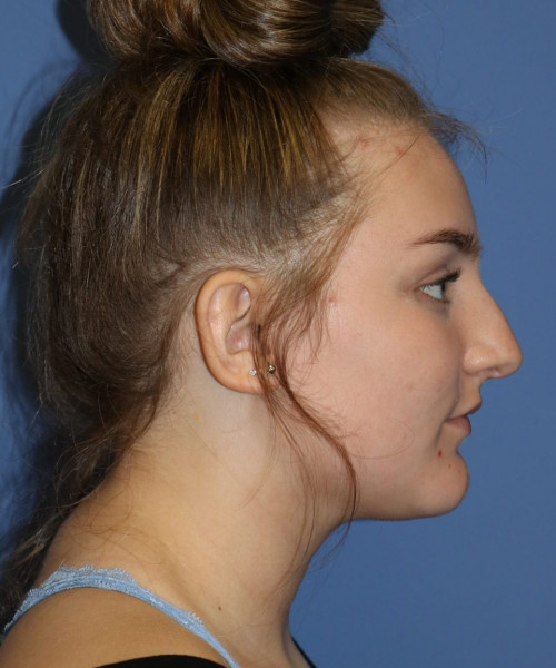 Rhinoplasty #6228 – click HERE for more views before photo. Individual results may vary.
