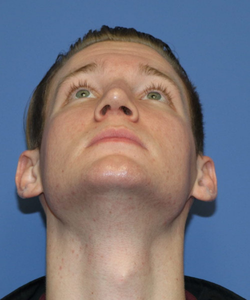 Rhinoplasty #6272 – click HERE for more views after photo. Individual results may vary.