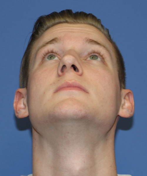 Rhinoplasty #6272 – click HERE for more views before photo. Individual results may vary.