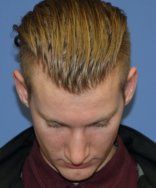 Rhinoplasty #6272 – click HERE for more views after photo. Individual results may vary.