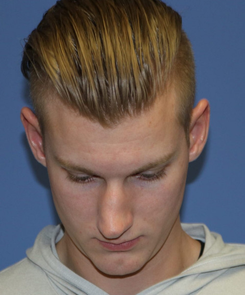 Rhinoplasty #6272 – click HERE for more views before photo. Individual results may vary.