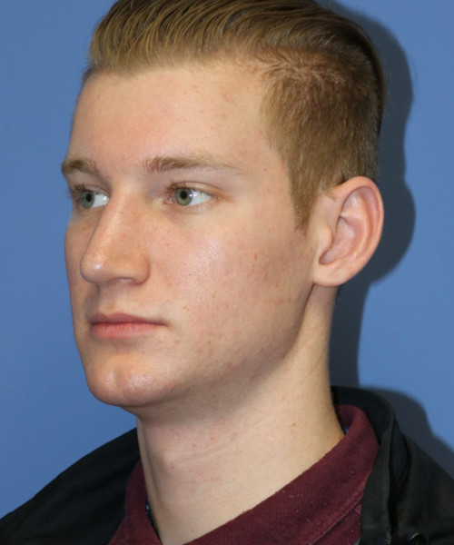 Rhinoplasty #6272 – click HERE for more views after photo. Individual results may vary.