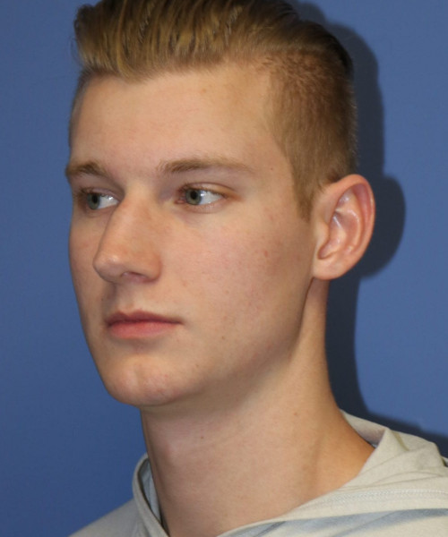 Rhinoplasty #6272 – click HERE for more views before photo. Individual results may vary.