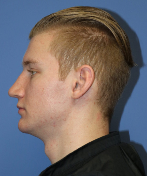 Rhinoplasty #6272 – click HERE for more views after photo. Individual results may vary.