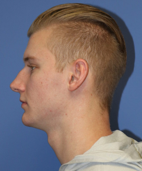 Rhinoplasty #6272 – click HERE for more views before photo. Individual results may vary.