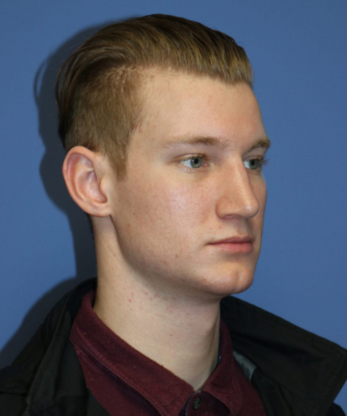 Rhinoplasty #6272 – click HERE for more views after photo. Individual results may vary.