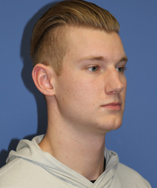 Rhinoplasty #6272 – click HERE for more views before photo. Individual results may vary.