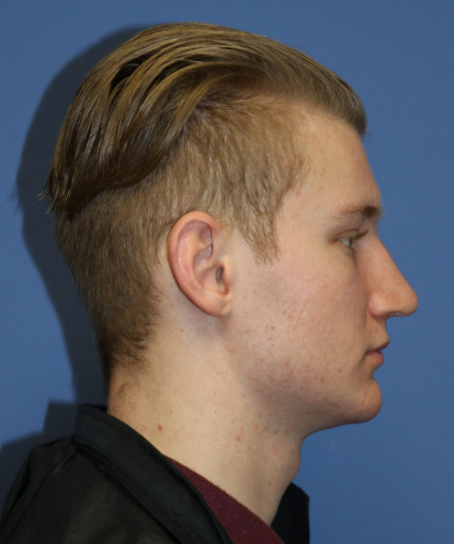 Rhinoplasty #6272 – click HERE for more views after photo. Individual results may vary.