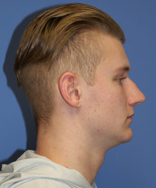 Rhinoplasty #6272 – click HERE for more views before photo. Individual results may vary.